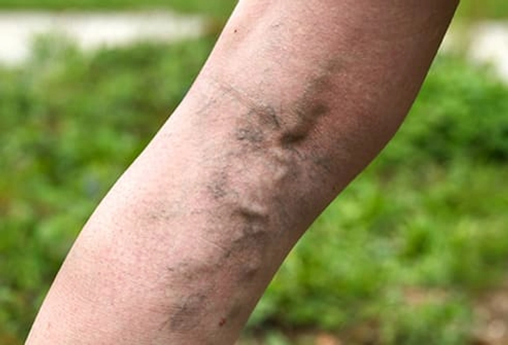Varicose Veins