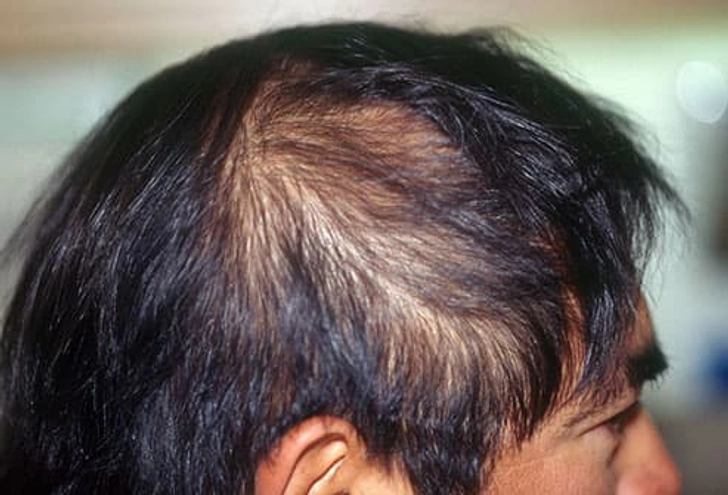 What Causes Telogen Effluvium?