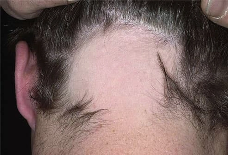 An Attack on Hair Follicles