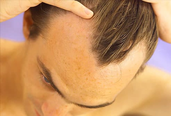 Genes Cause 90% of Male Hair Loss