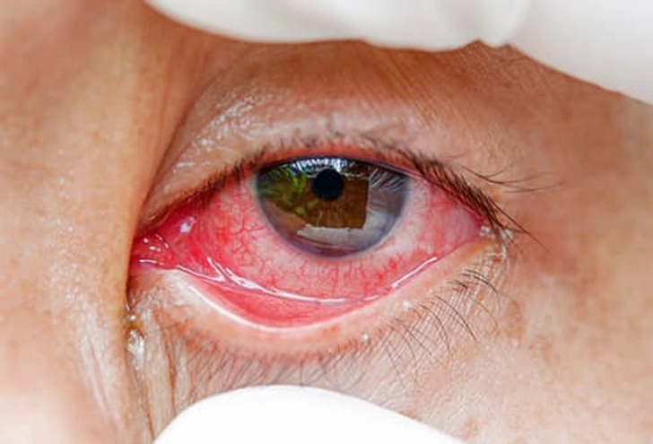 Type 4: Eyes