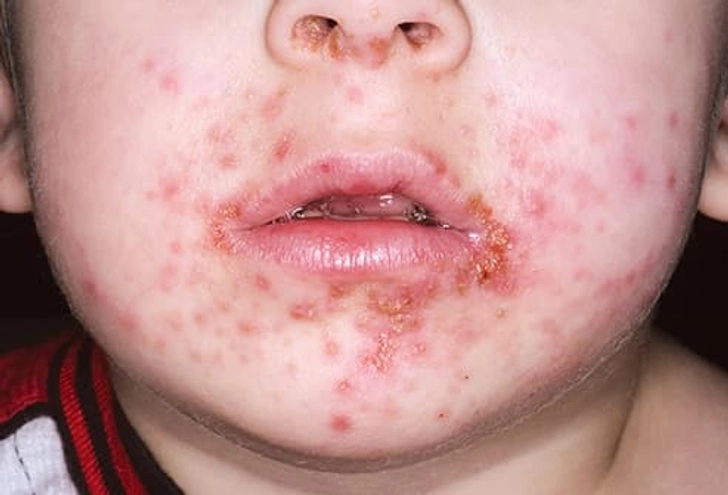 Impetigo