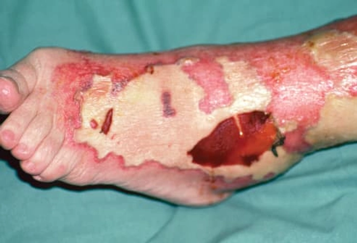 Necrotizing Fasciitis