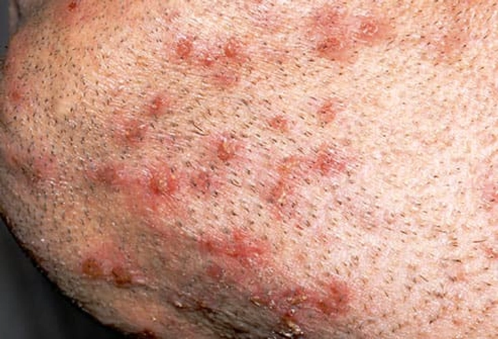 Folliculitis