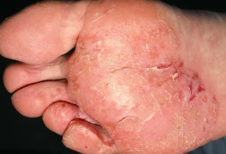 Athlete’s Foot