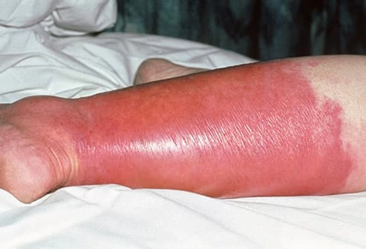 Cellulitis