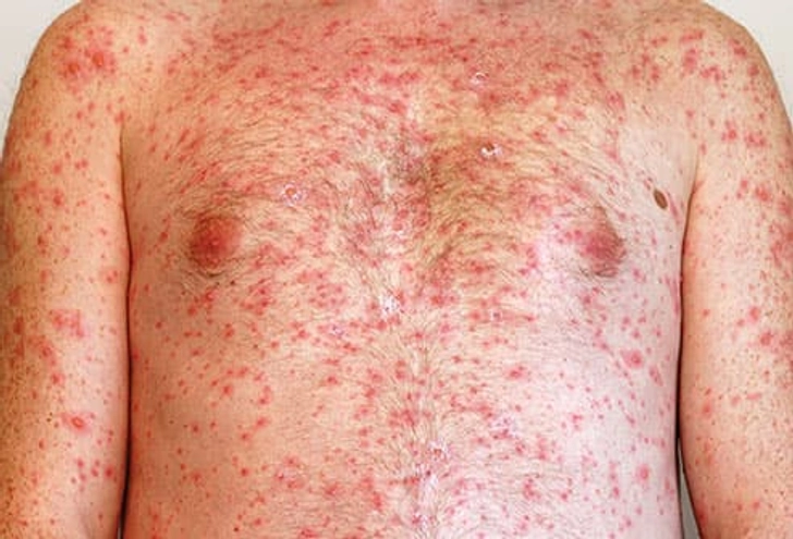 Chickenpox