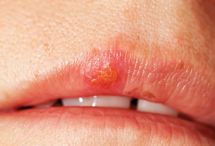 Cold Sores