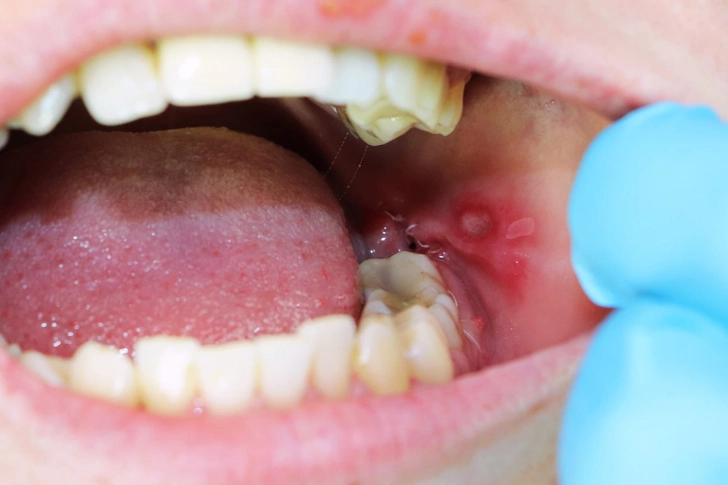 Canker Sores