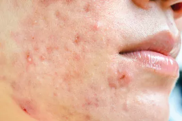 Acne is common in adolescent males.