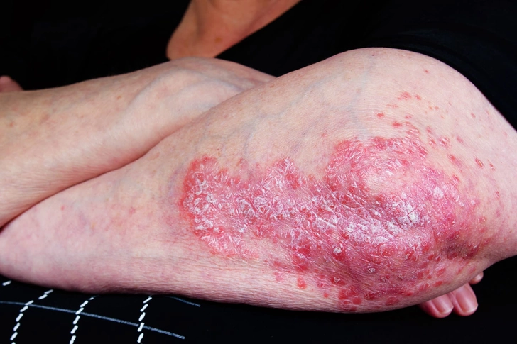 Psoriasis