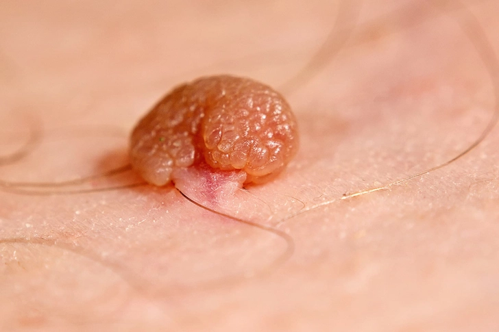 Skin Tags