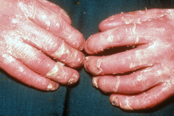 Acrodermatitis Enteropathica
