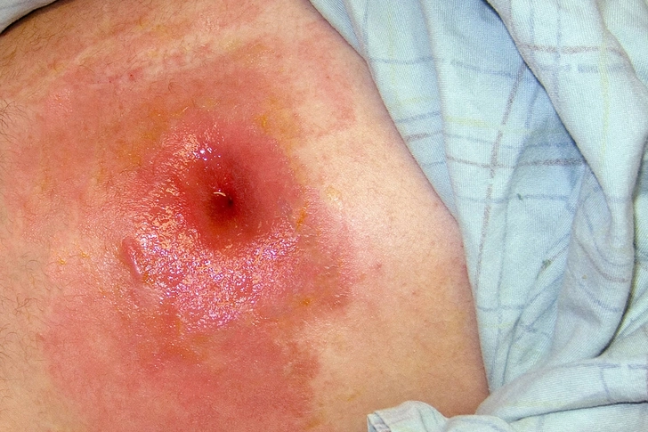 Enterocutaneous Fistulas