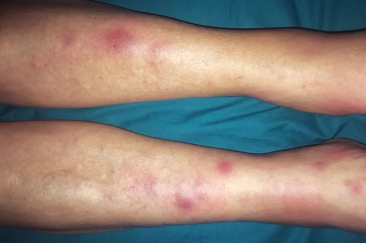 Erythema Nodosum Erythema Nodosum