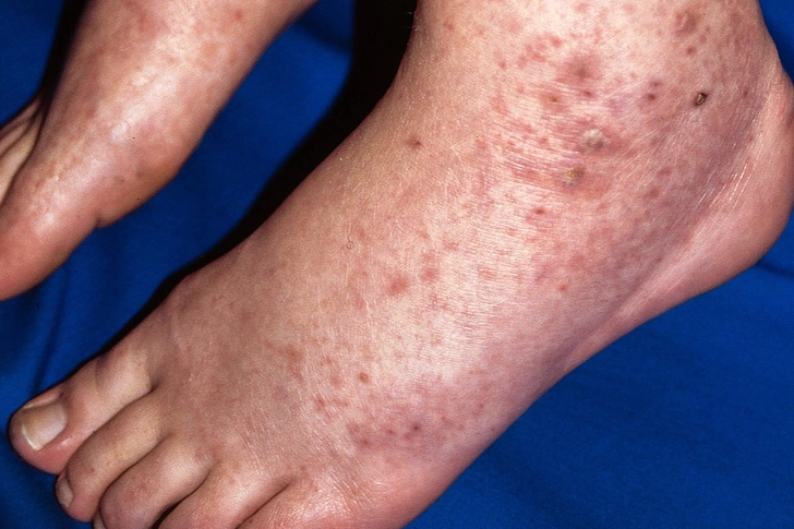 Leukocytoclastic Vasculitis