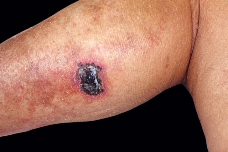 Pyoderma Gangrenosum