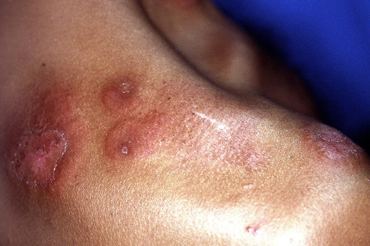 Sweet’s Syndrome