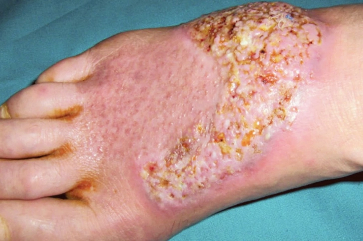 Pyoderma Vegetans
