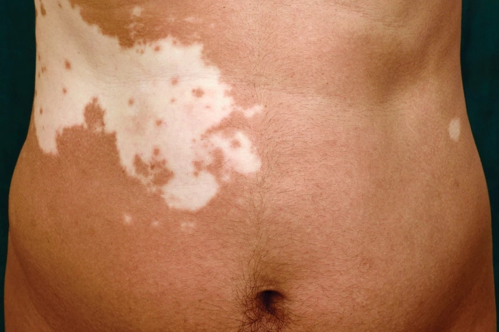 Vitiligo