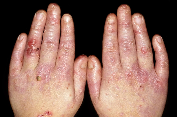 Epidermolysis Bullosa Acquisita