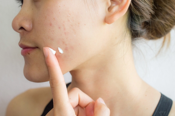 Natural Oils for Acne Natural Oils for Acne