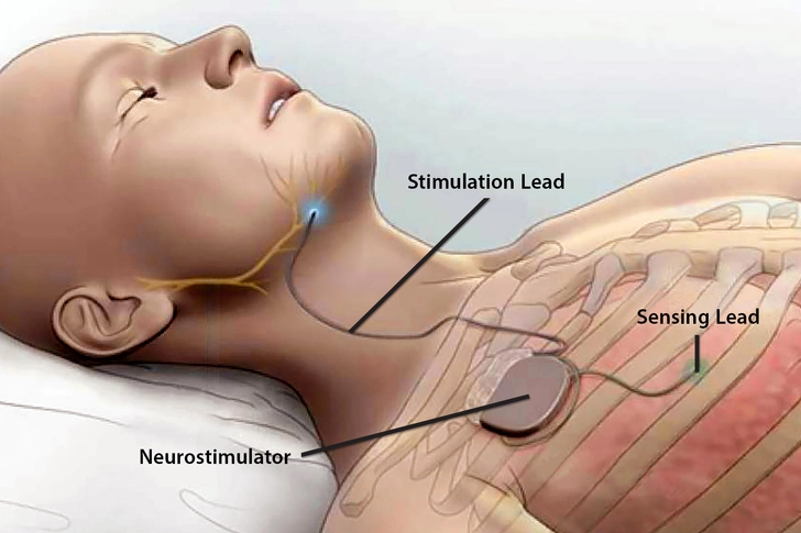 Upper Airway Stimulation Upper Airway Stimulation