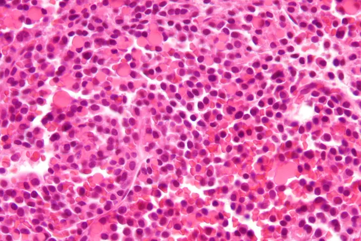 What Should You Know About Your Multiple Myeloma?