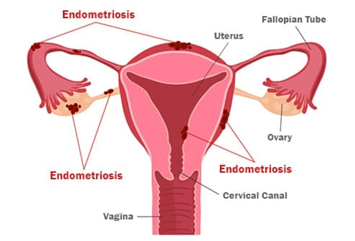 Endometriosis