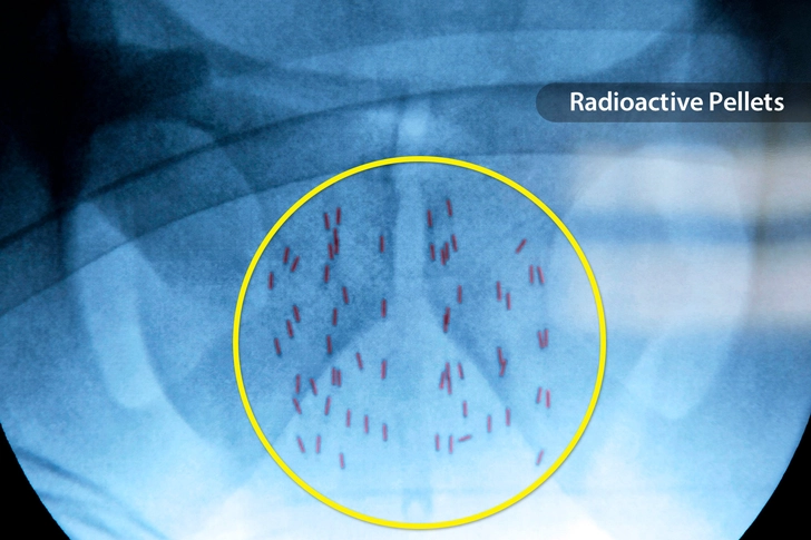 Salvage Brachytherapy