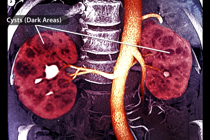 Polycystic Kidney Disease
