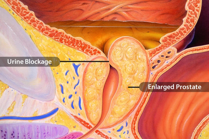 Urine Blockage
