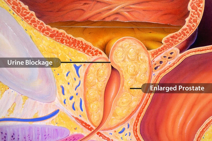 Urine Blockage Urine Blockage