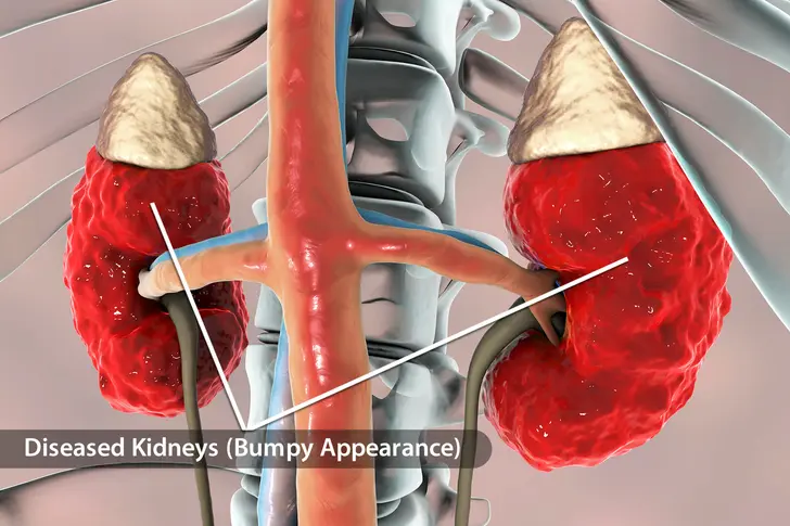 Chronic Kidney Disease (CKD)