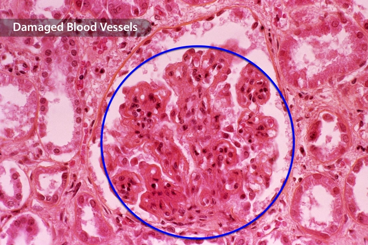 Lupus