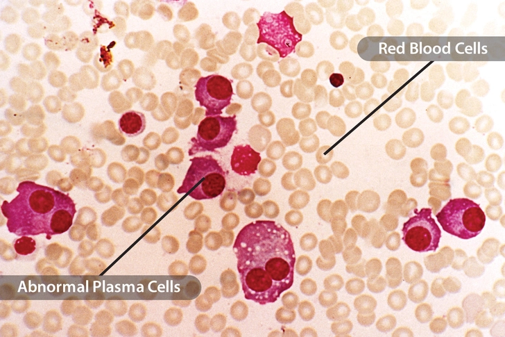 Multiple Myeloma