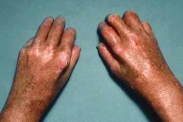 Sclerodactyly is when the skin on your fingers or toes gets thick and tight. It's a common sign of systemic scleroderma. (Photo Credit: SPL/Science Source)