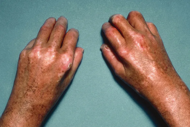 photo of scleroderma