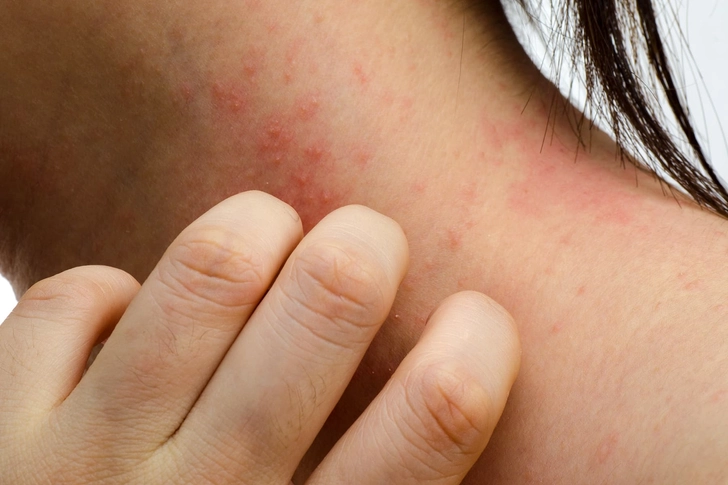 Eczema Eczema