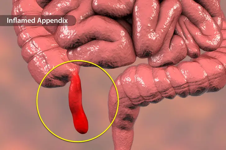 What Is Appendicitis?