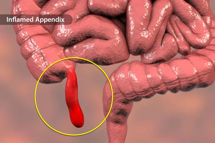 What Is Appendicitis? What Is Appendicitis?