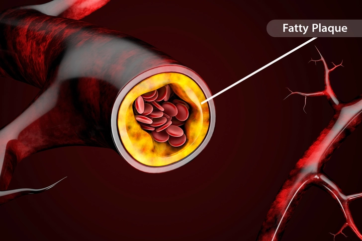 Hardening of the Arteries (Arteriosclerosis)