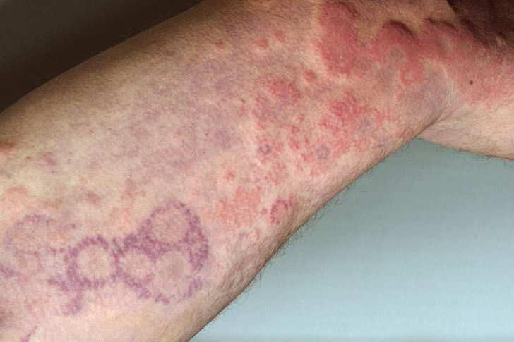 Livedo Reticularis Rash Livedo Reticularis Rash