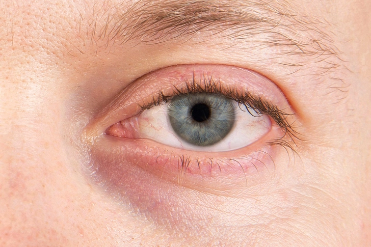 Dry Eye