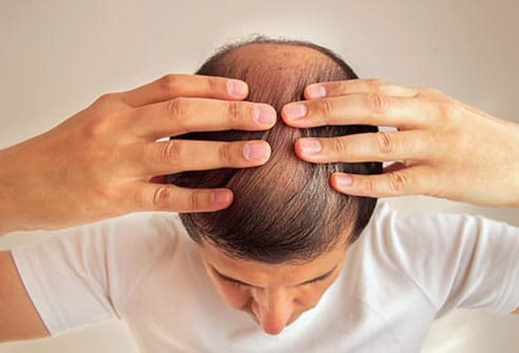 Hair Loss