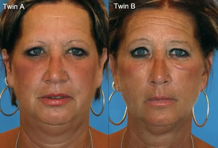 Which Twin Is the Smoker? Which Twin Is the Smoker?