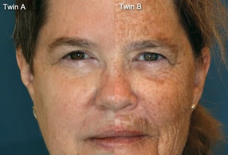 Age Spots