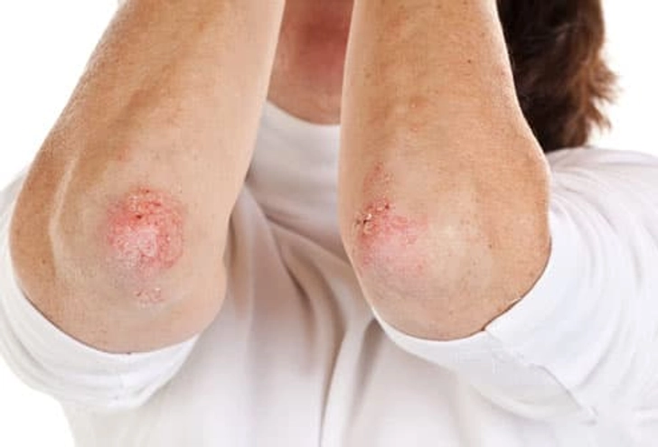 Psoriasis
