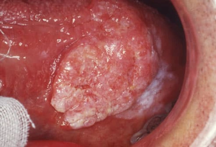 Oral Cancer