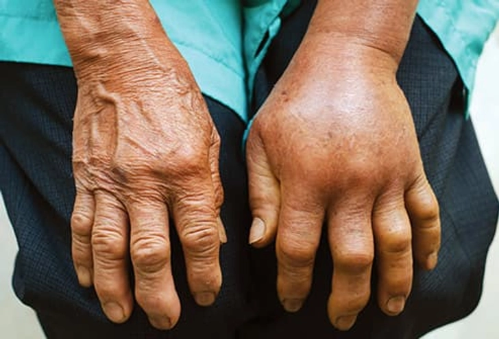Treatment: First Aid Treatment: First Aid
